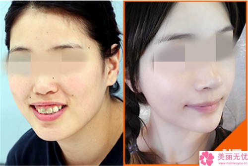 整容要花多少錢(qián)就整一張臉？深度解析全臉整形費(fèi)用構(gòu)成與預(yù)算攻略